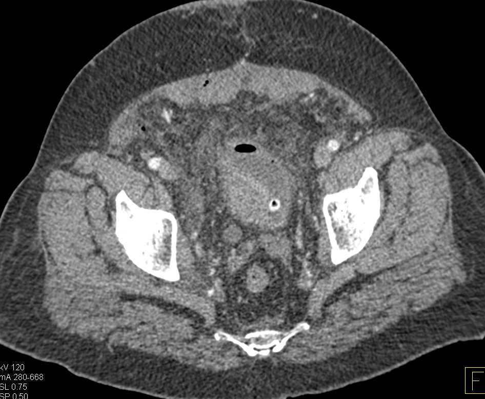 Bulky Bladder Cancer with Hydronephrosis - CTisus CT Scan