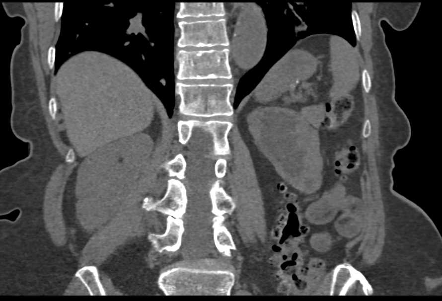 Left Hydronephrosis due to a Tumor of the Ureterovesical Junction (UVJ) - CTisus CT Scan