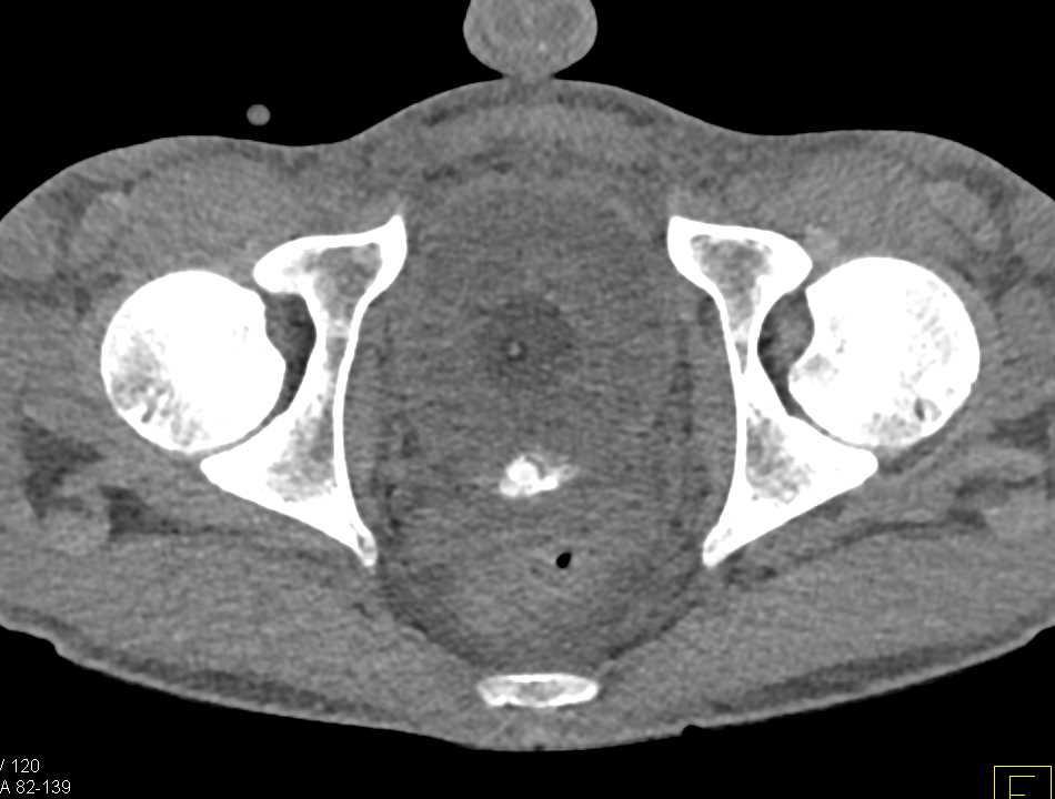 CT Cystogram with Leak and Multiple Clots in the Bladder - CTisus CT Scan