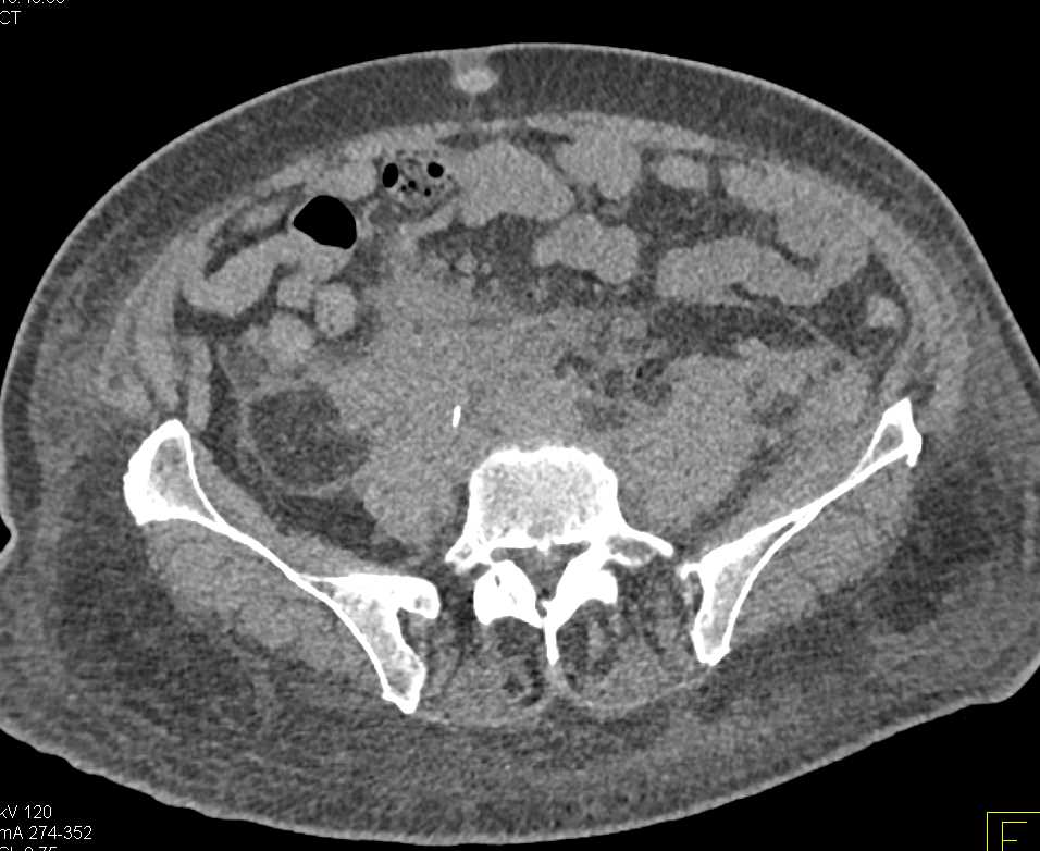 Retroperitoneal Infiltration by Tumor - CTisus CT Scan