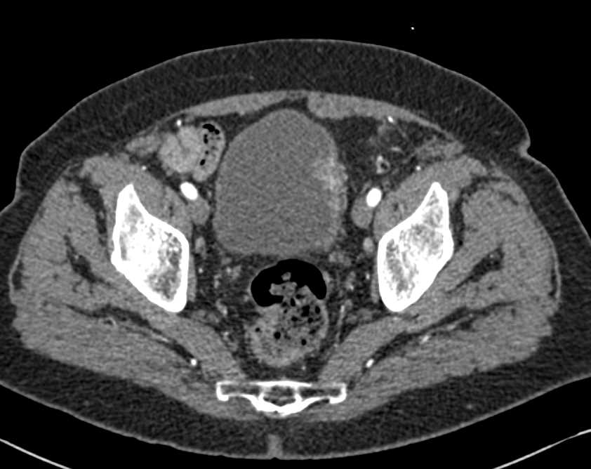 Incidental Carcinoma of the Left Bladder Wall - CTisus CT Scan