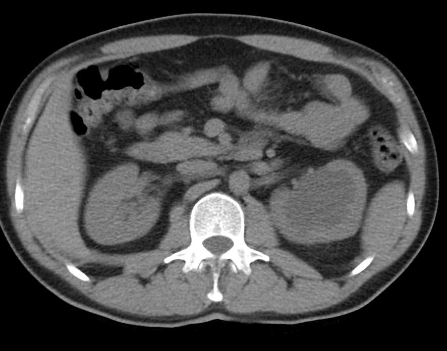 Obstructed Left Ureter With Ectopic Insertion - CTisus CT Scan