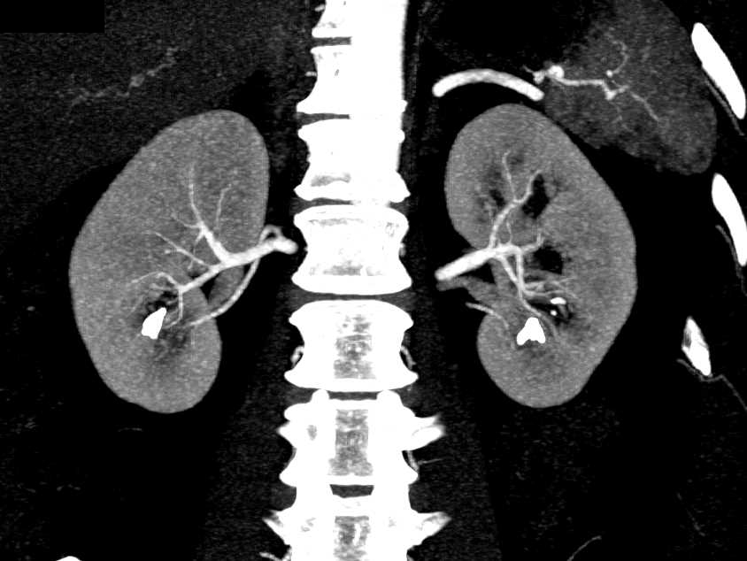 Bilateral Renal Calculi with Unusual Cystic Structure Near Urethra - CTisus CT Scan