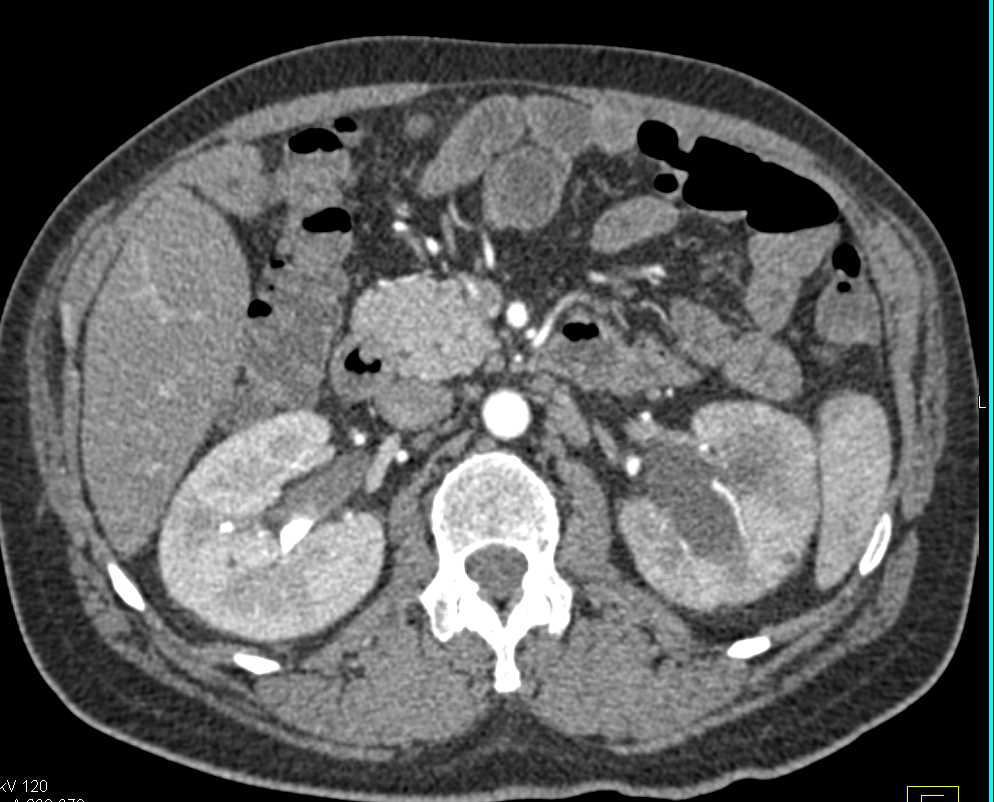 Large Seroma in the Right Lower Quadrant Displacing the Bladder - CTisus CT Scan