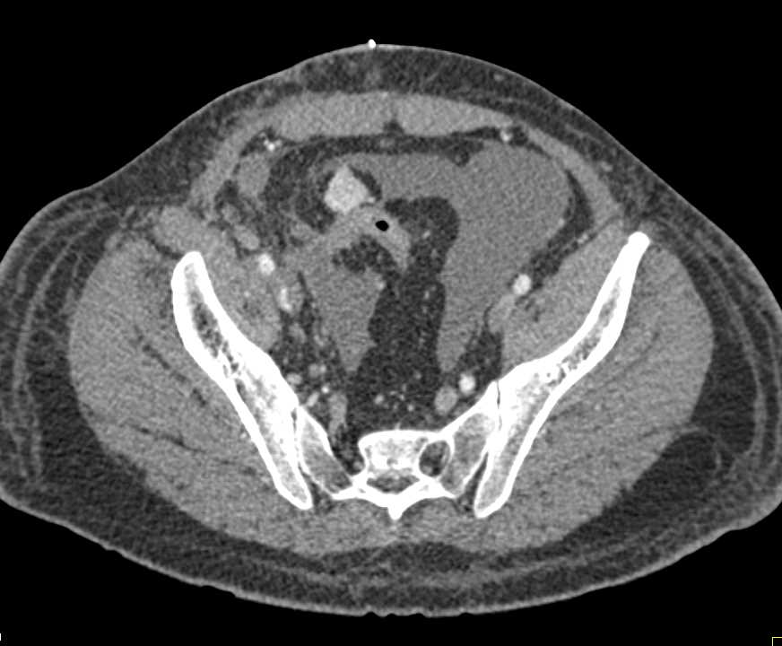 Testicular Cancer with Low Density Adenopathy - CTisus CT Scan