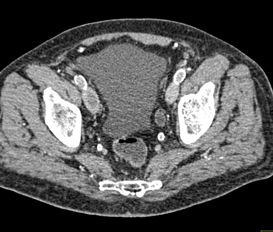 Bladder Cancer Seen best at 11 O'clock - CTisus CT Scan