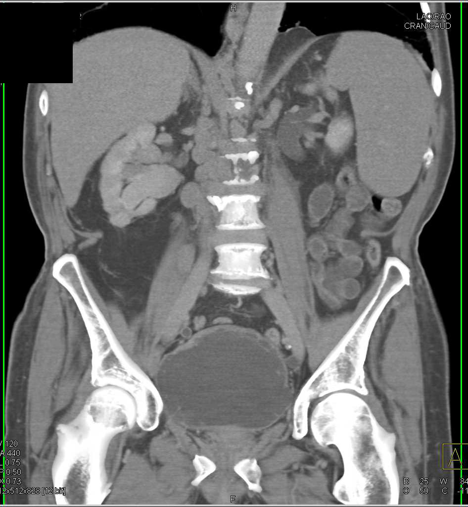 Bladder Cancer with Large Bilateral Pelvic Adenopathy - CTisus CT Scan