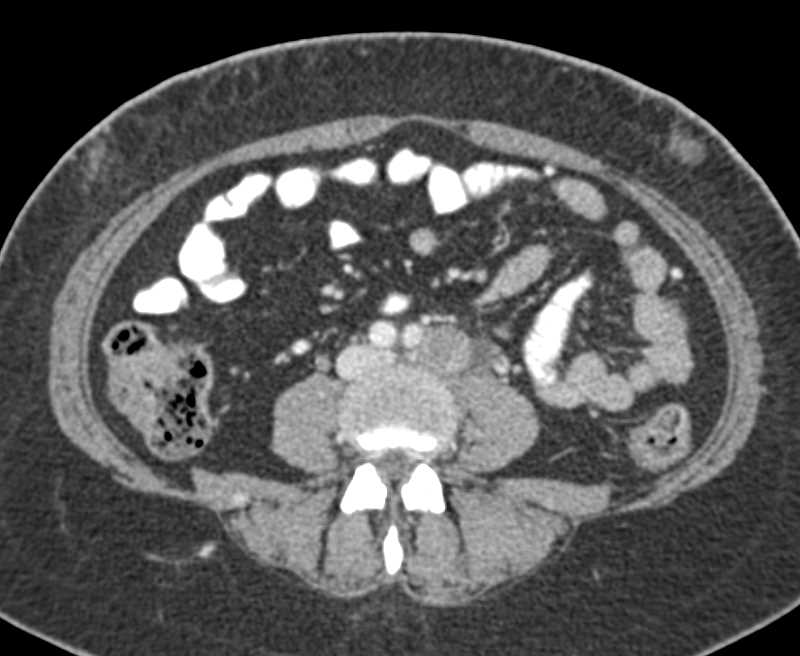 Prostate with Extensive Adenopathy - CTisus CT Scan