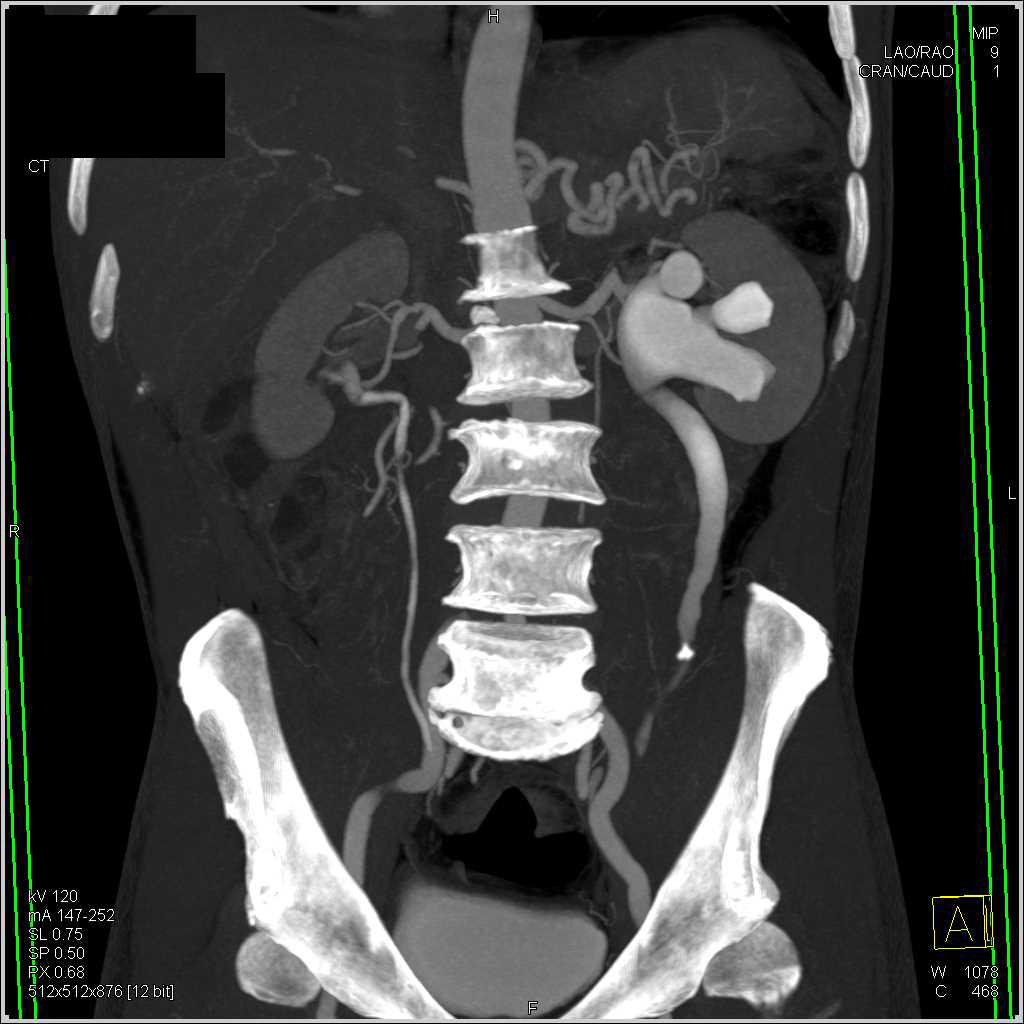 Obstructed Left Ureter with a Ureteral Calculi - Genitourinary Case