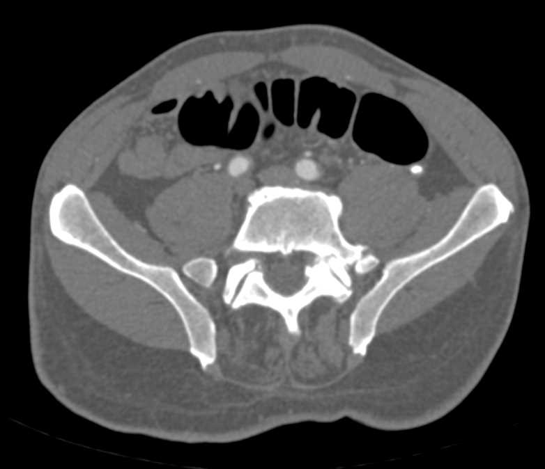 Obstructed Left Ureter with a Ureteral Calculi - CTisus CT Scan