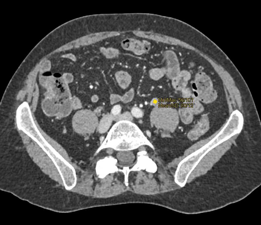 Left Hydronephrosis due to Transitional Cell Cancer (TCC) in the Mid Left Ureter - CTisus CT Scan