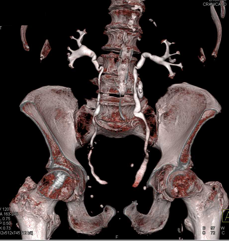 Diffuse Bladder Cancer - CTisus CT Scan