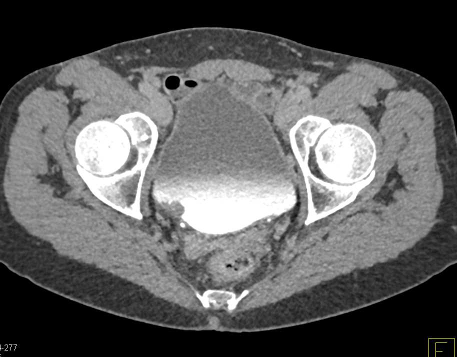 Multifocal Bladder Cancer - CTisus CT Scan