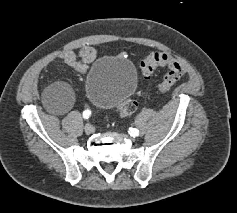 1 cm Urachal Carcinoma in Dome of the Bladder - CTisus CT Scan