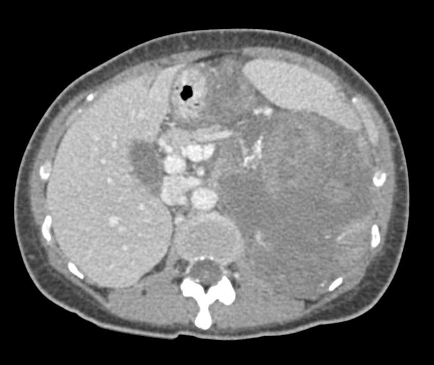 Left Adrenal Carcinoma with Hemorrhage - CTisus CT Scan