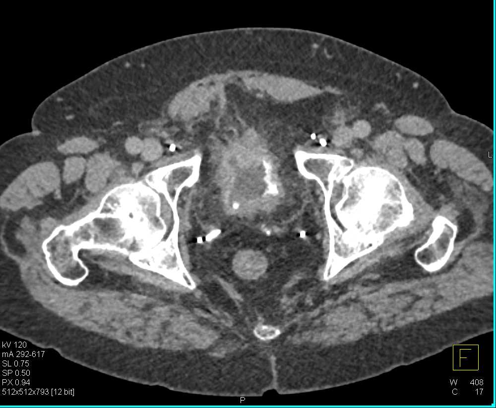 Diffusely Infiltrating Bladder Cancer - CTisus CT Scan