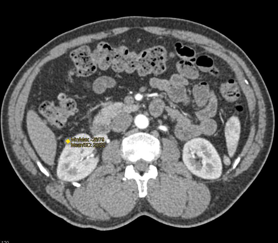 Incidental Bladder Cancer - CTisus CT Scan