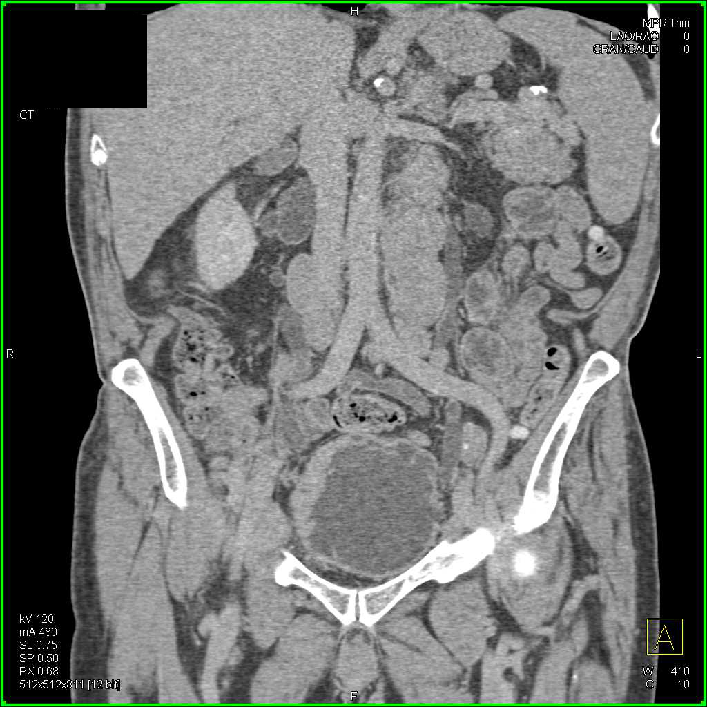 Bladder Cancer and External Right Iliac Nodes - CTisus CT Scan