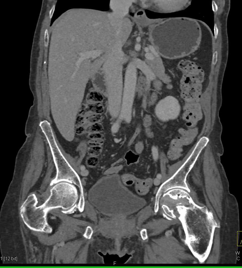 Bladder Cancer and Large Right Inguinal Nodes - CTisus CT Scan