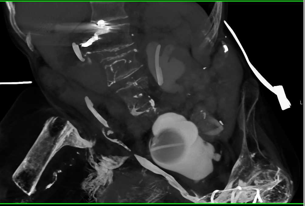 Leak from Suprapubic Catheter - CTisus CT Scan