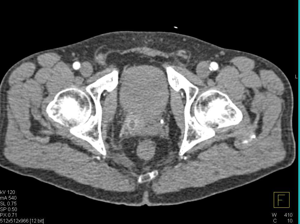 Prostate Abscess - CTisus CT Scan