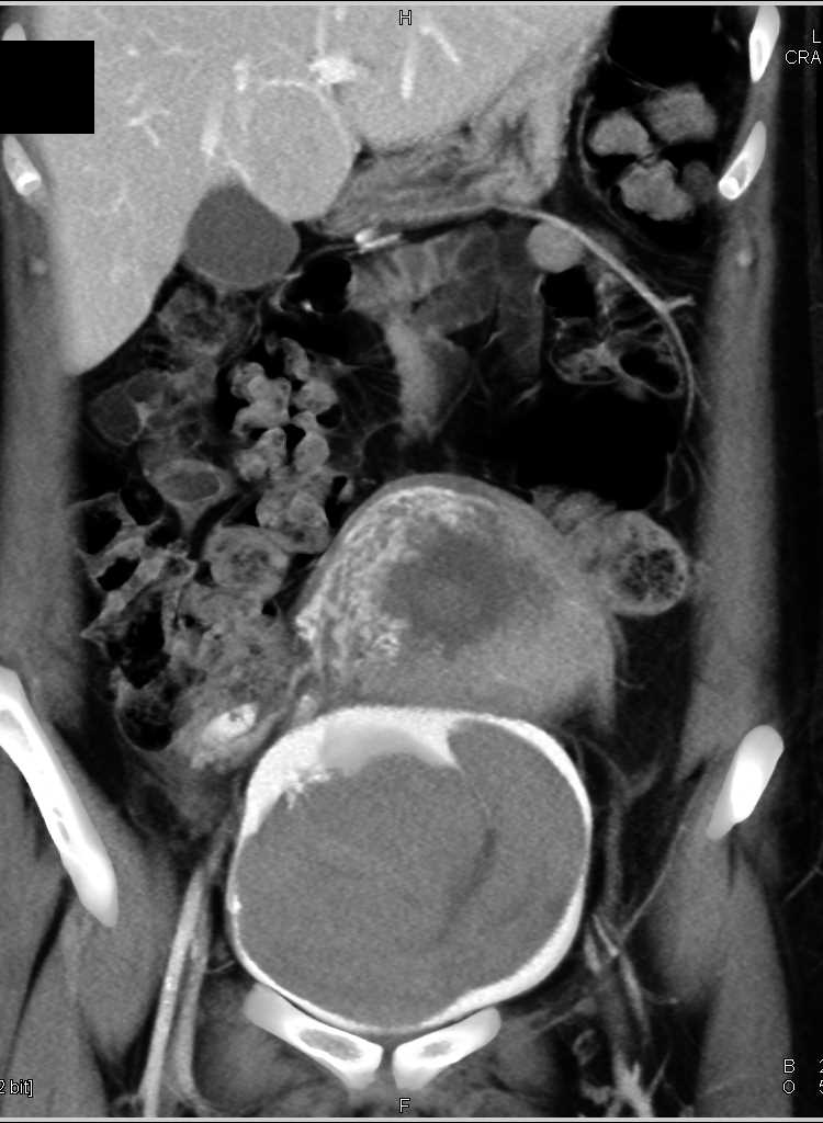 Bladder Hematoma - CTisus CT Scan