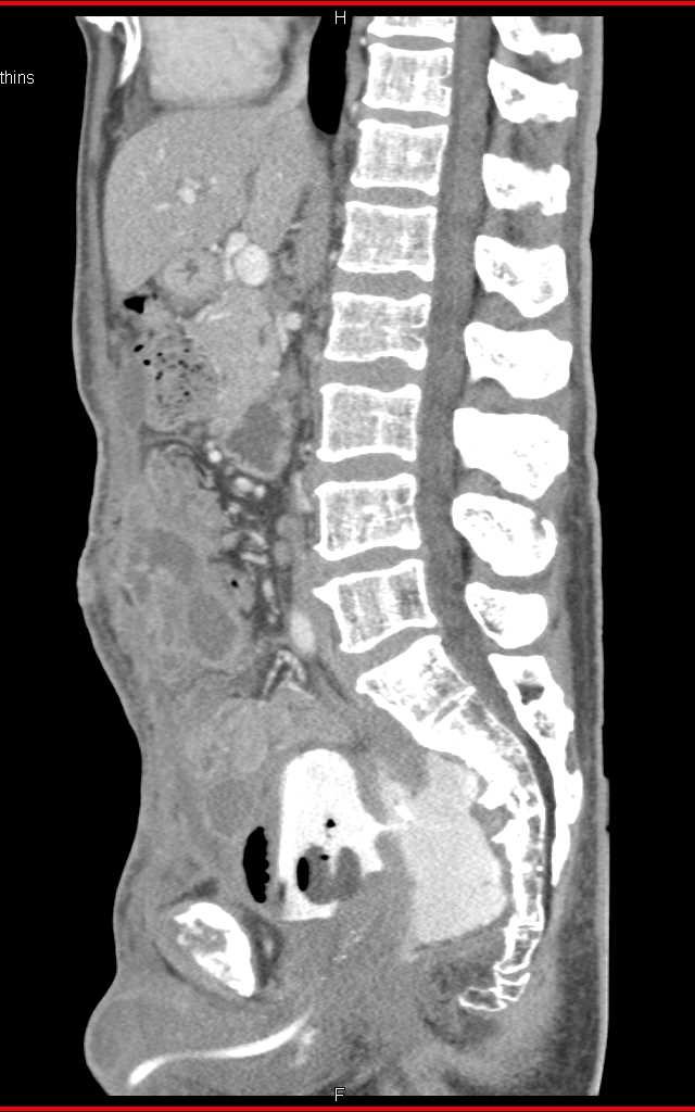 Fistulae from the Bladder to Rectal Space on CT Cystogram - CTisus CT Scan