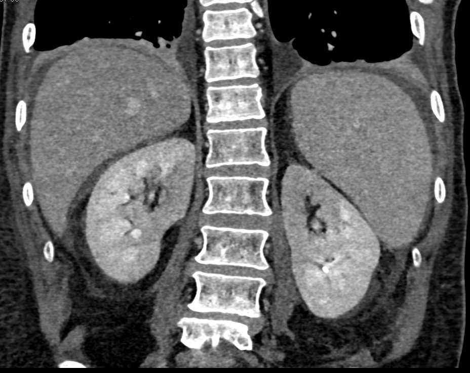Patchy Renal Enhancement due to Inflammation - CTisus CT Scan