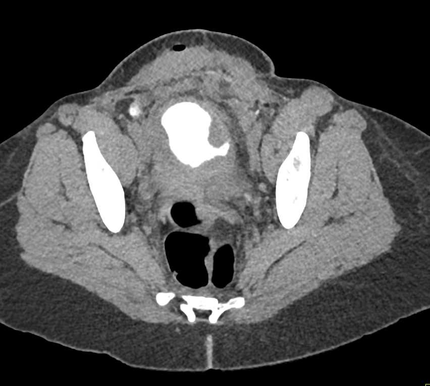 CT Cystogram with Contrast Extravasation from the Bladder - CTisus CT Scan