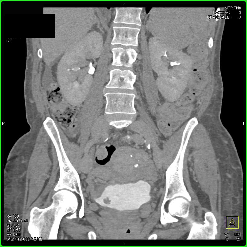 Carcinoma of the Right Bladder Wall - CTisus CT Scan