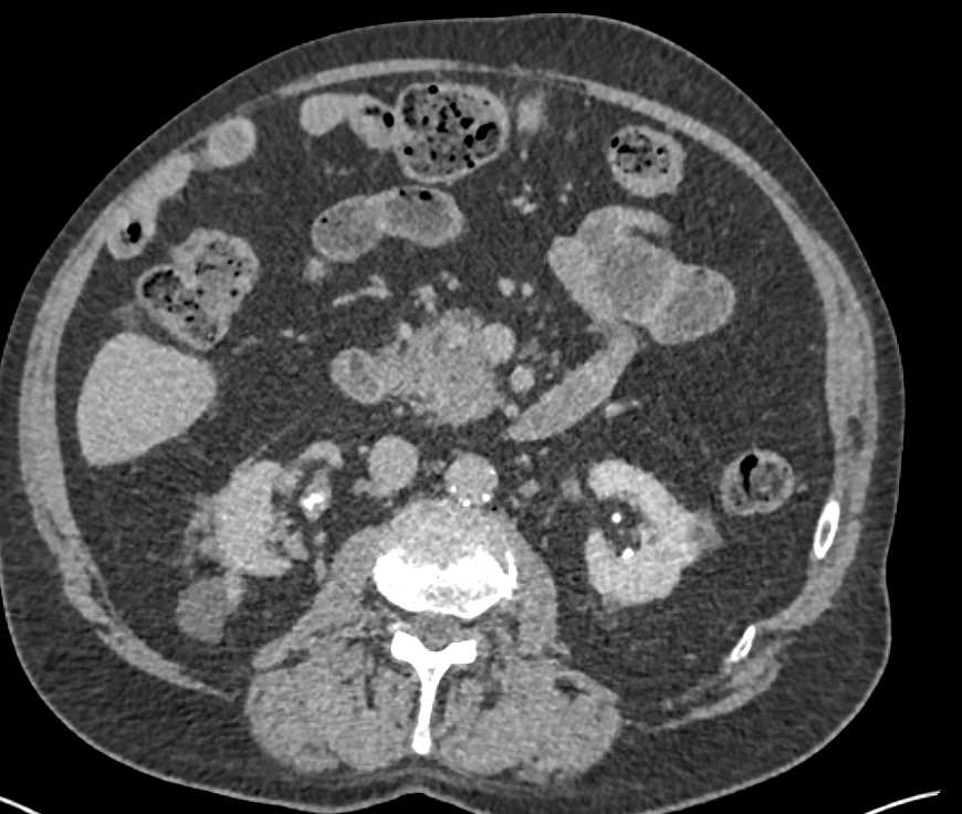 Incidental Bladder Cancer in a Patient with End Stage Renal Disease - CTisus CT Scan