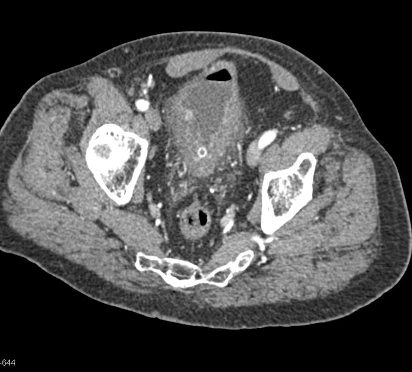 Diffusely Infiltrating Bladder Cancer - CTisus CT Scan