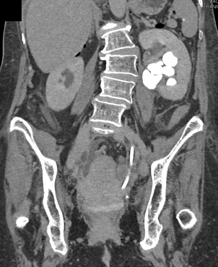 Transitional Cell Cancer (TCC) Involving Left Renal Pelvis and Ureter - CTisus CT Scan