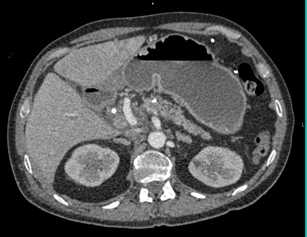 Invasive Bladder Cancer and Papillary Necrosis - CTisus CT Scan