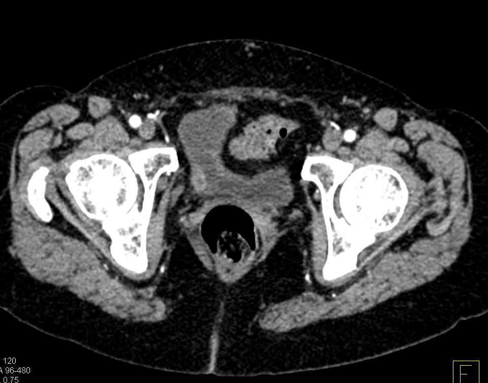 Incidental Bladder Cancer on Right Wall of the Bladder - CTisus CT Scan