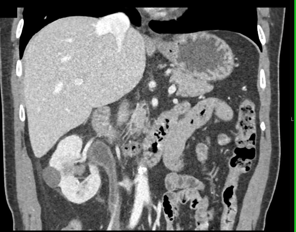 Transitional Cell Carcinoma of the Right Renal Pelvis, Ureter and Bladder - CTisus CT Scan