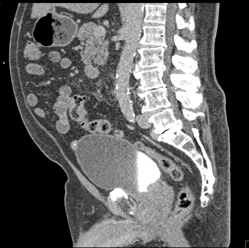 Urachal Carcinoma - CTisus CT Scan