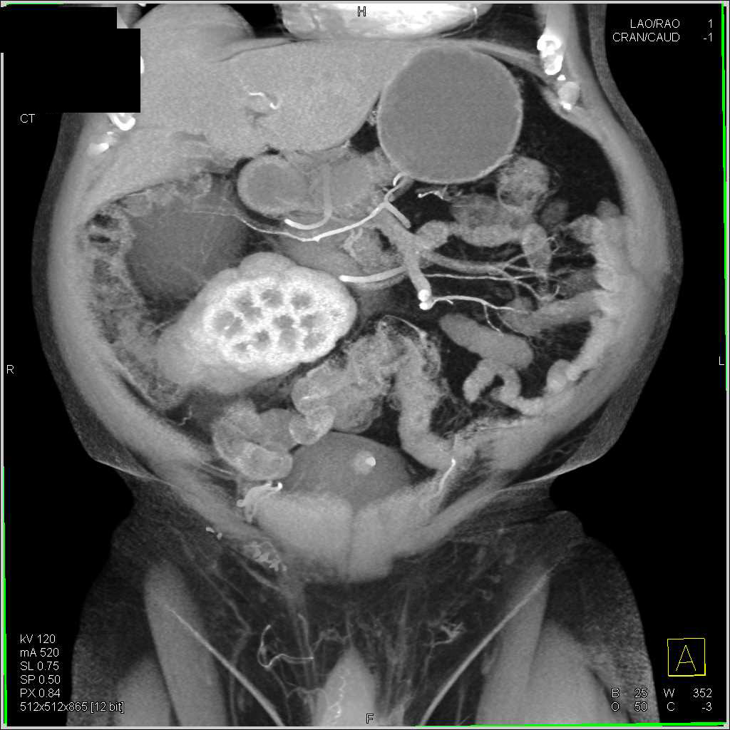 Urachal Carcinoma - CTisus CT Scan