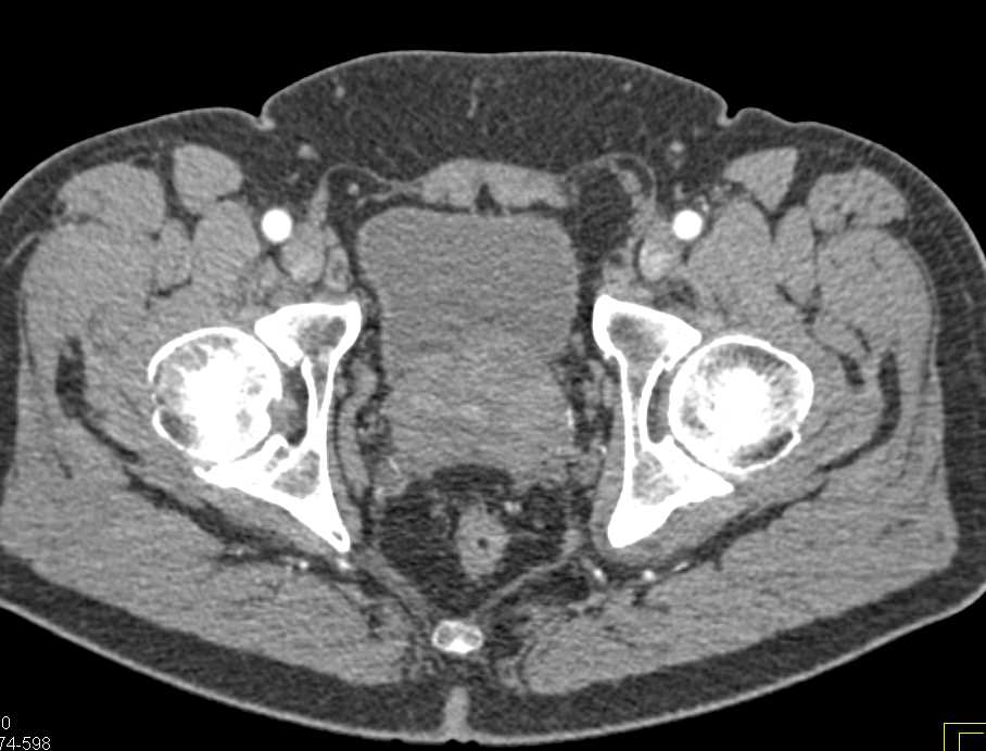 Right Hydronephrosis in a Patient with Prostate Cancer - CTisus CT Scan