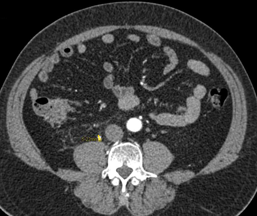 Obstructing Stone in Right Ureter - CTisus CT Scan