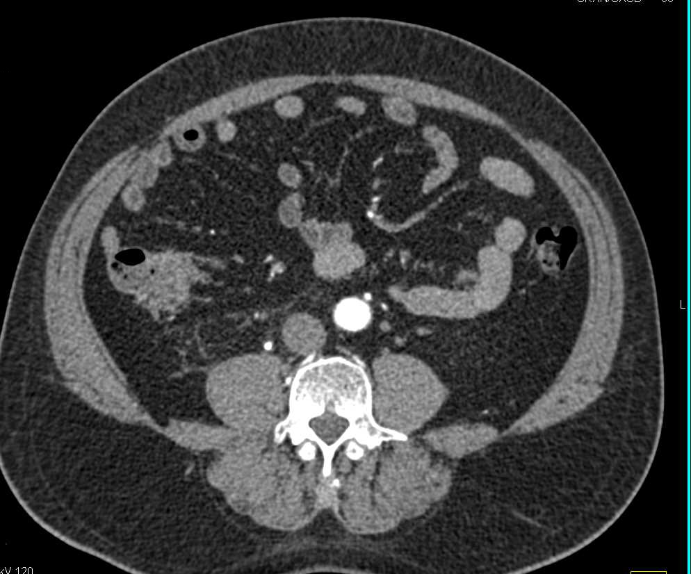 Obstructing Stone in Right Ureter - CTisus CT Scan