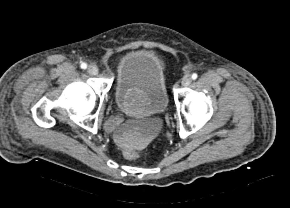 Gastric Cancer with Carcinomatosis with Incidental Bladder Cancer - CTisus CT Scan