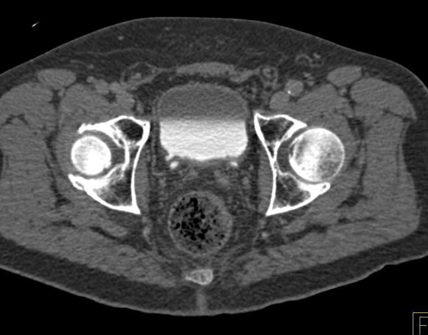 Prostate Seed Migrates into the Bladder - CTisus CT Scan