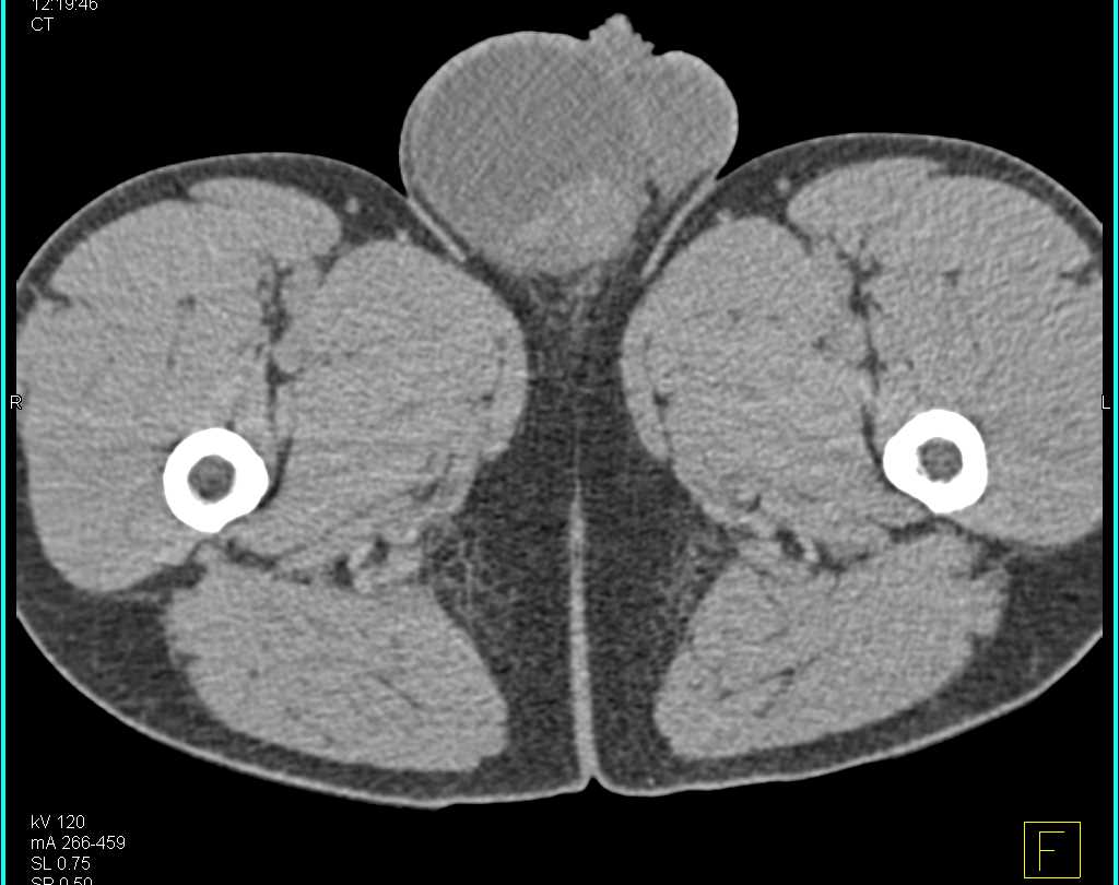 Seminoma with Extensive Para-aortic Adenopathy - CTisus CT Scan