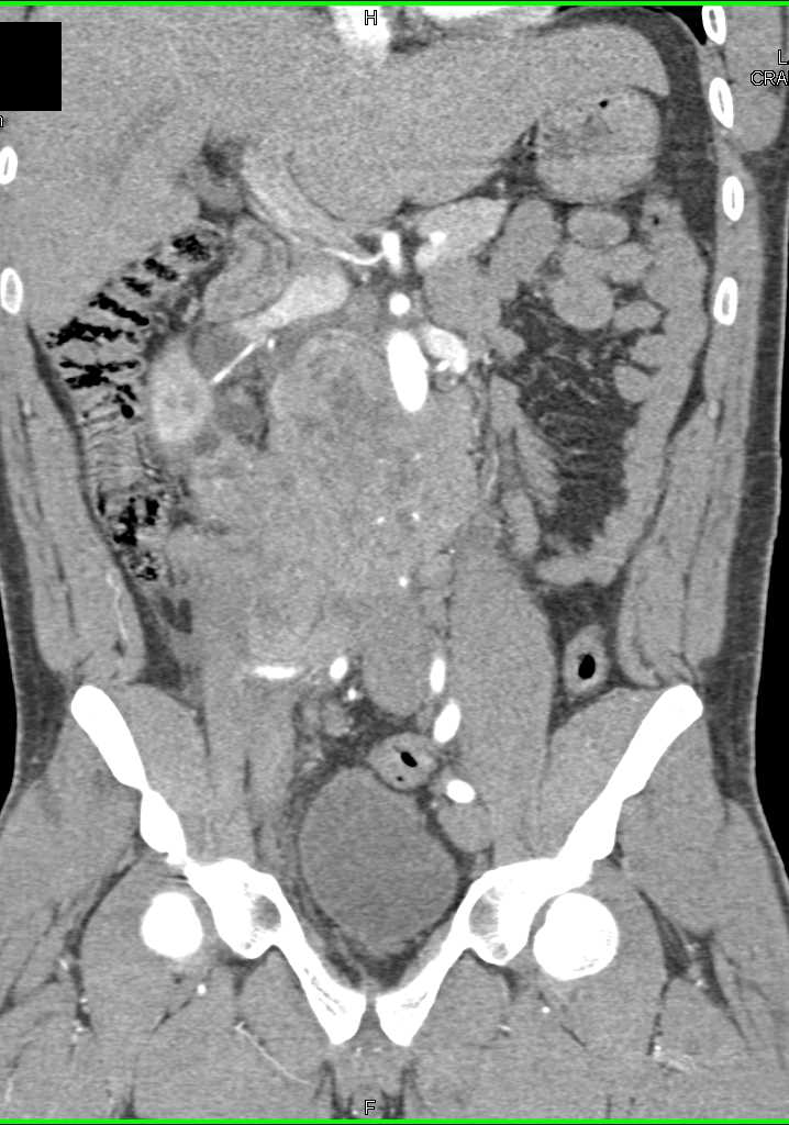 Seminoma with Extensive Para-aortic Adenopathy - CTisus CT Scan