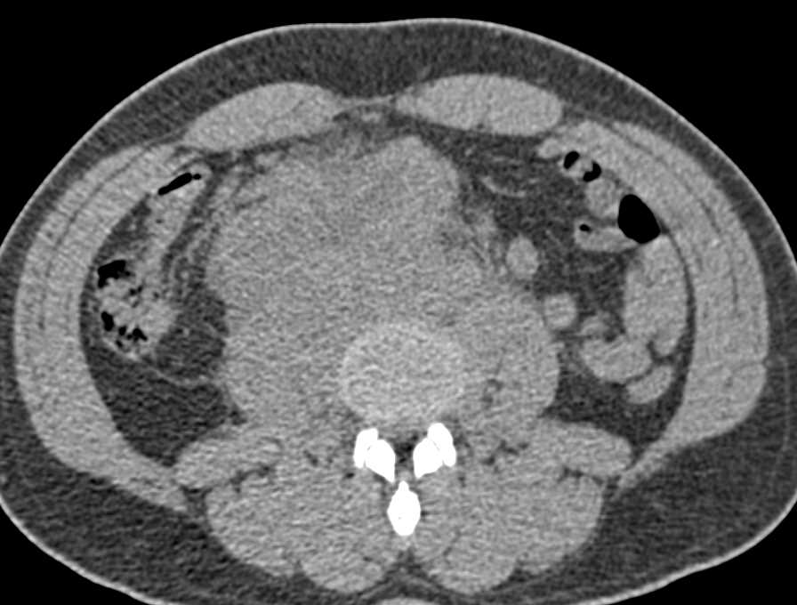 Seminoma with Extensive Para-aortic Adenopathy - CTisus CT Scan