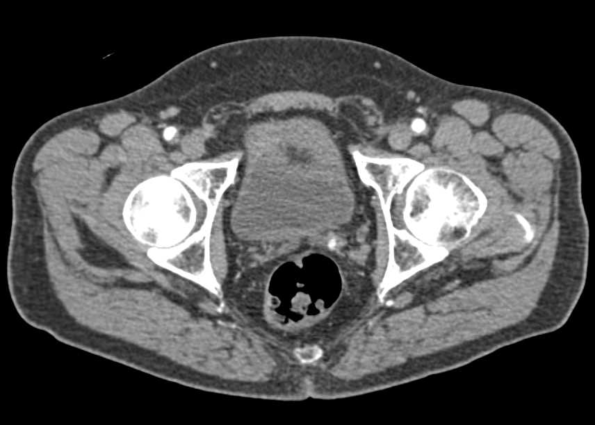 Metastatic Renal Cell Carcinoma to the Left Seminal Vesicle - CTisus CT Scan