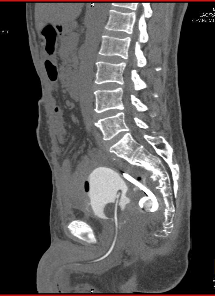 Posterior Bladder Wall Perforation - CTisus CT Scan