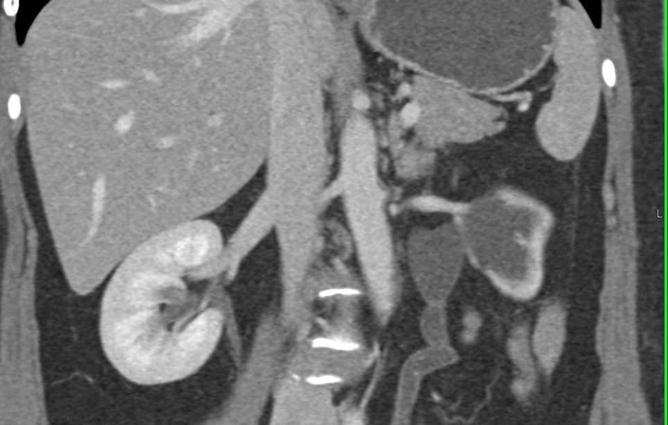 Transitional Cell Cancer (TCC) Left Distal Ureter - CTisus CT Scan