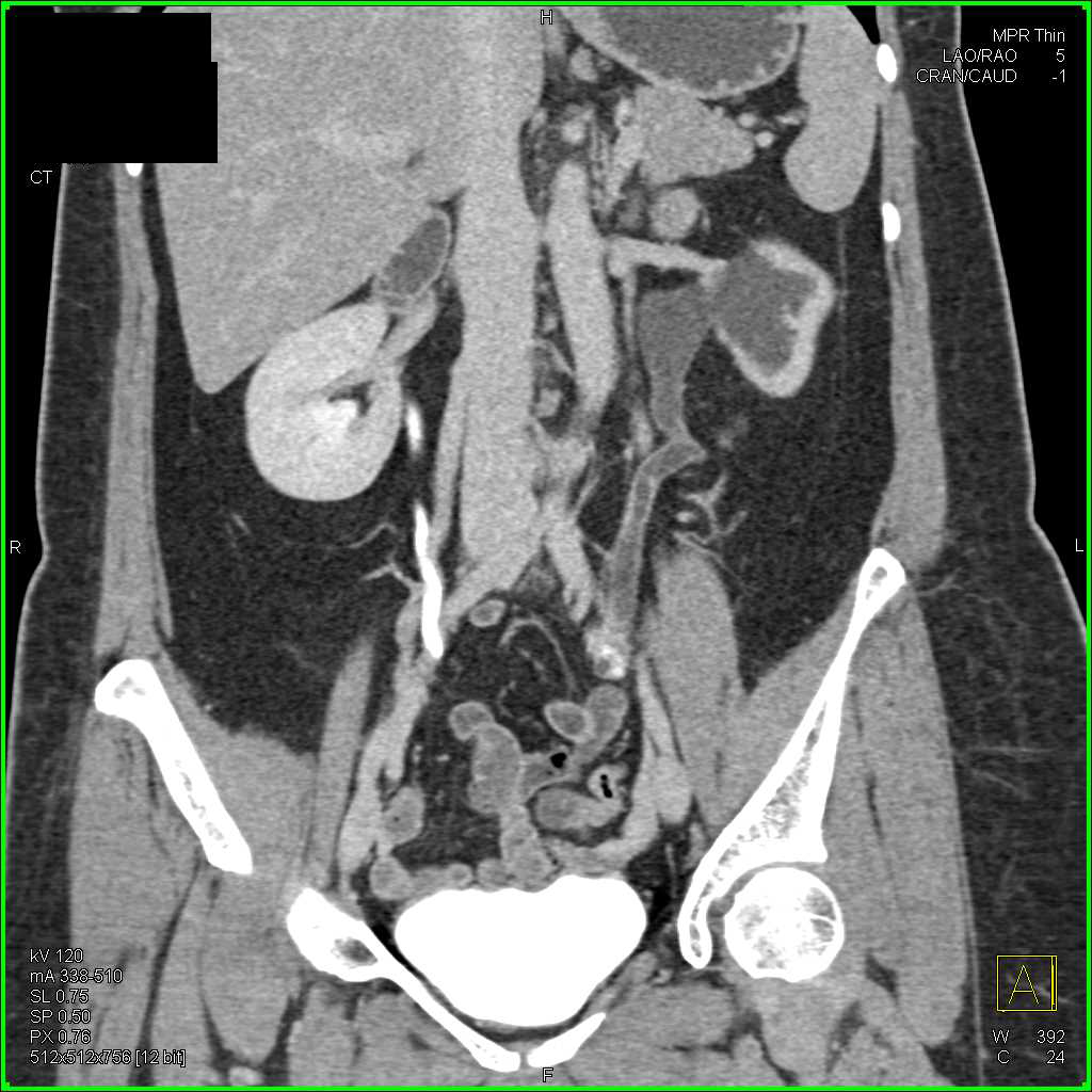 Transitional Cell Cancer (TCC) Left Distal Ureter - CTisus CT Scan